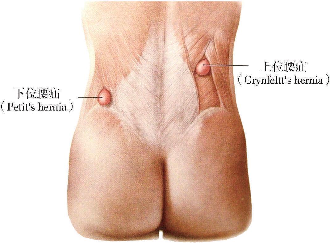 第十三節(jié) 腰筋膜疝注射術